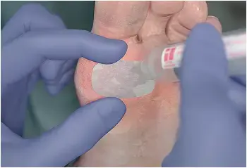 Hydrate with sterile saline, do not soak