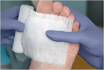 Cover and wrap with secondary dressings. Reassess at next patient treatment visit. PuraPly AM or PuraPly XT will naturally be resorbed into the wound and is not intended to be removed. Subsequent application is at the discretion of the healthcare practitioner.